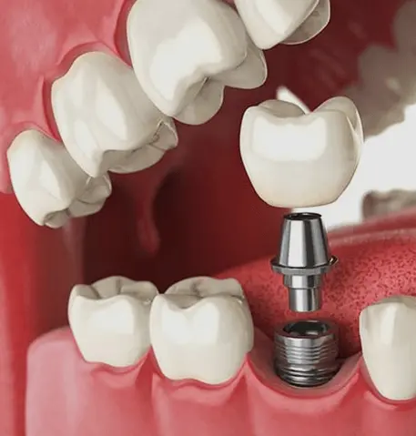 dental-implant